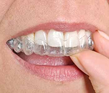 Cincinnati area dentist explains orthodontic treatment and benefits with Invisalign