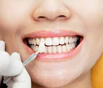 Dentist explains what you need to know about dental veneers treatment near Bridgetown