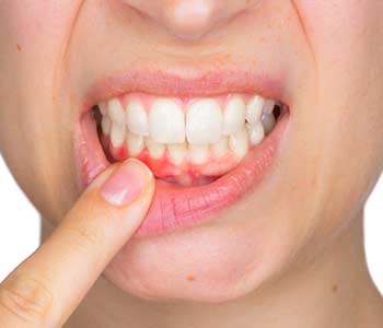 Get relief from painful, swollen gums with periodontal disease treatment near Dent, OH