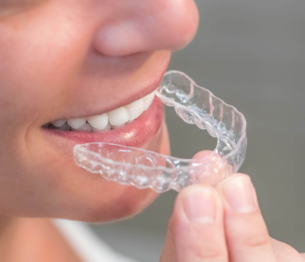 Overcome teeth clenching and grinding with Dental Bite Guards for bruxism