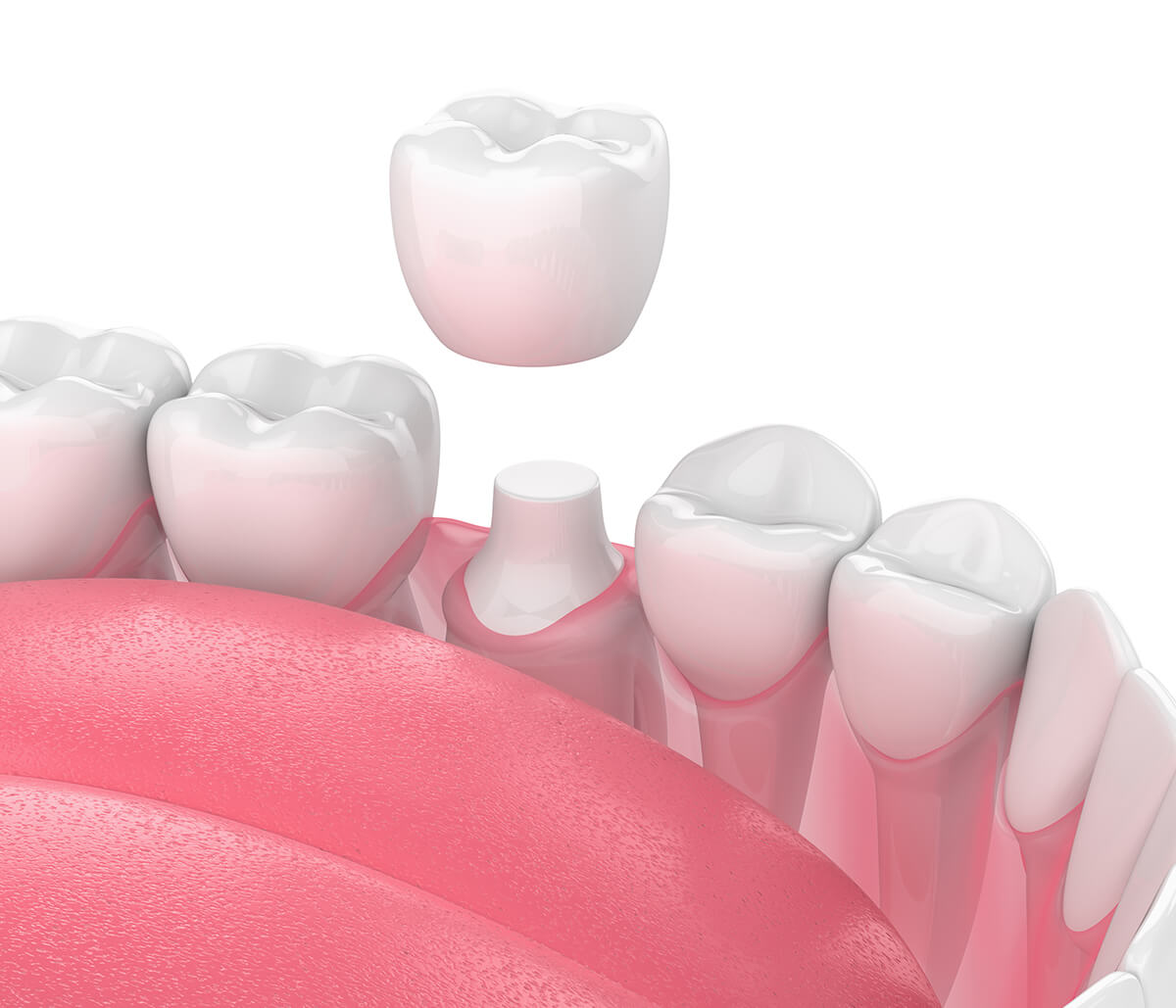 Dental Crown for Broken Tooth in Cincinnati OH Area